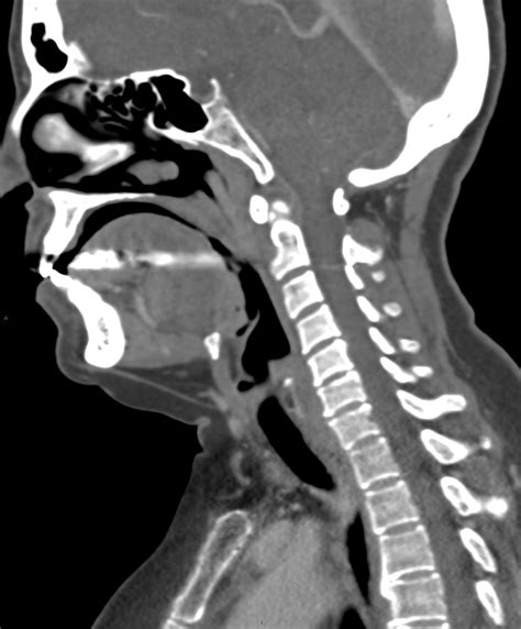 Neck ct.  This picture taken by my favourite sitehttps://radiopaedia.  When contrast is us...