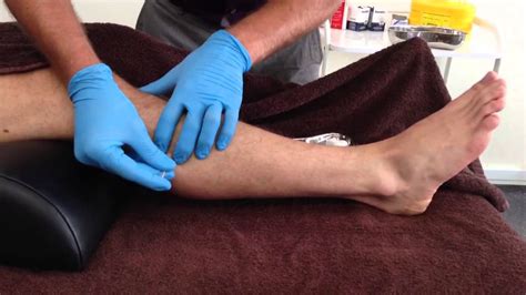 Needling Motor Points of the Peroneus Muscle - ASE Seminars LLC