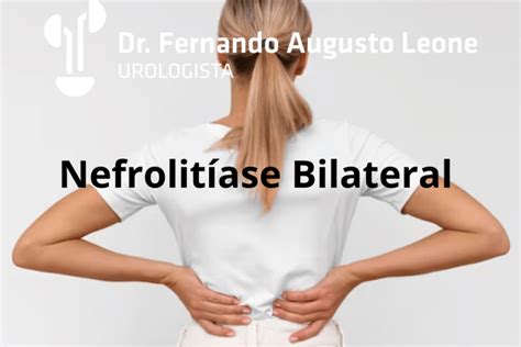 Nefrolitiasis bilateral no obstructiva tratamiento.  Se desarrolla como...