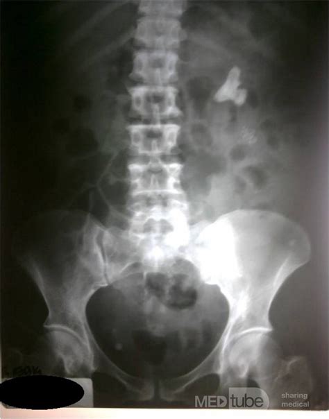 Nefrolitiasis izquierda no obstructiva que significa.  Cuando la obstruc...