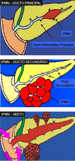 Neoplasia Mucinosa Papilar Intraductal De Pancreas De Ducto …