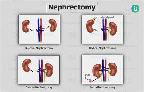 Nephrectomy Definition purpose and types