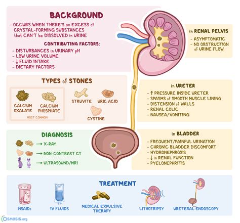 Nephrolithiasis Differential Diagnoses - Medscape