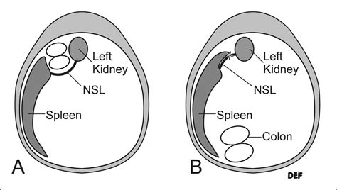 Nephrosplenic Space Ablation - University of Florida