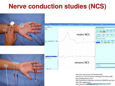 Nerve Conduction Study near Jefferson, GA WebMD