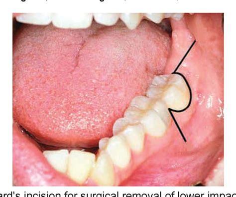 Nerve injuries after third molar removal - PubMed