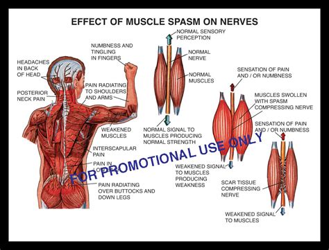 Nerve spasm in head