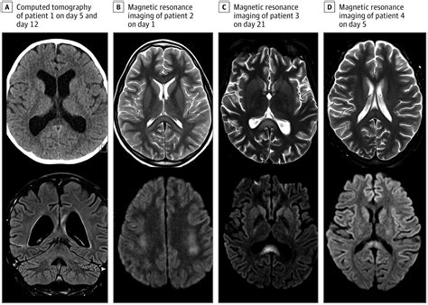 Neurologic and Radiographic Findings Associated With COVID-19 …