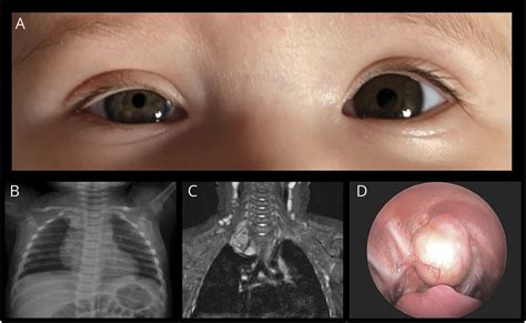 Neurology: Horner