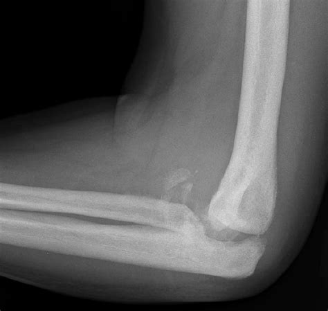 Neuropathic (Charcot) Joint of the Elbow - Orthobullets