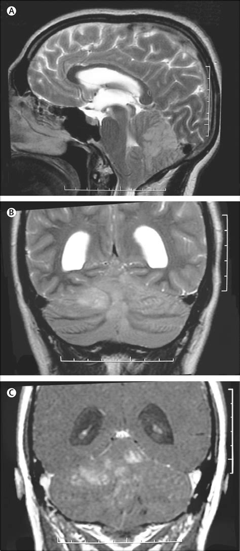 Neuroschistosomiasis: clinical symptoms and pathogenesis