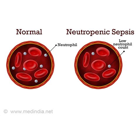 Neutropenic Sepsis - clinicaltoolkit.scot.nhs.uk