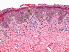 Nevi of Ota and Ito Workup: Other Tests, Histologic Findings - Medscape