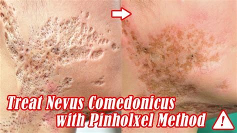 Figure 1. Nevus comedonicus. (Courtesy of Bryan Anderson, MD) Nevus comedonicus may vary markedly in severity, promoting some authors to divide patients …. 
