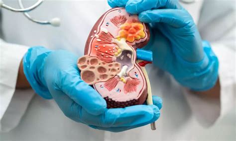 New Study Finds Chronic Kidney Disease Remains …