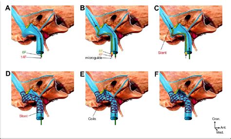 New Treatment of Vertigo Caused by Jugular Bulb …