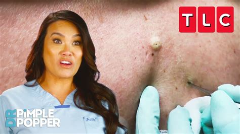 New pimple popper. .  ...