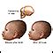 Newborn head molding UF Health, University of …