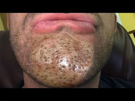 #pimpleproblem Popping! BLACKHEAD REMOVAL 2023! ACNE Treatment. TOP RELAXING SPA VIDEO 2023#newvideo #002Acnetreatment #boil #phamvuong#Severeboilinfections...