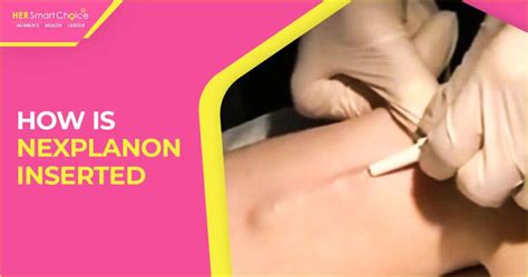 Nexplanon when is it effective