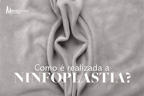 Ninfoplastia: o que é, como é feita e recuperação - Tua …