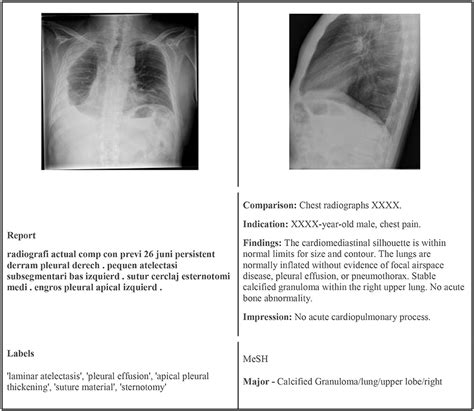 NAD on chest xray: NAD - No acute (active) disease is 