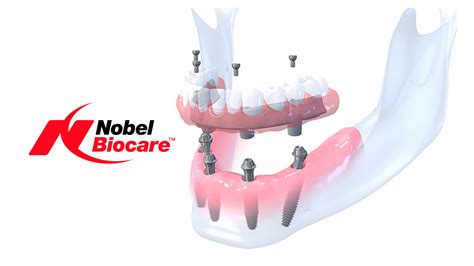 Nobel biocare implants cost.  All-on-4 package featuring four Nobel Bio...