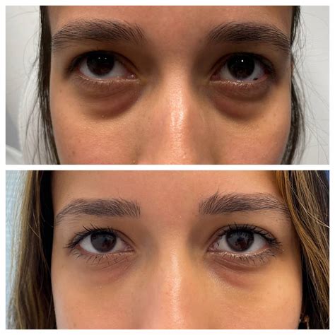 Non-Surgical Eyelid Lift Atlanta MM Eye Lift Buckhead