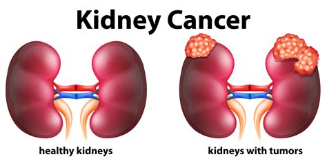 Non-cancerous tumours and conditions of the kidney