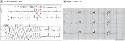 Non-prodromal syncope and frequent premature ventricular …