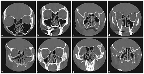 Noncontrast coronal sinus CT scans. a This is a normal study.