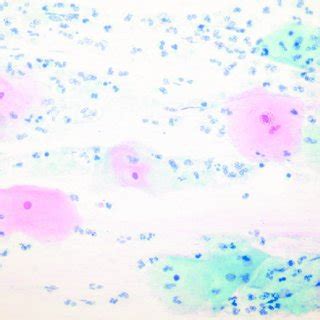 Nonspecific inflammation in an OP user. Note lactobacilli in background