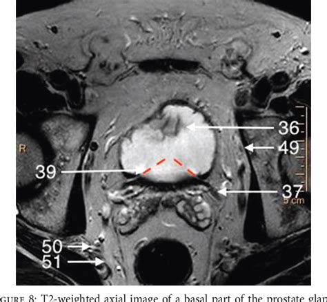 Normal 3T MR Anatomy of the Prostate Gland and Surrounding Structures