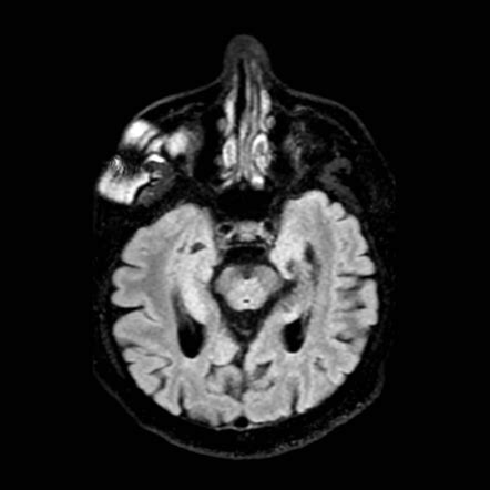 Normal DaT (I-123 Ioflupane) scan - Radiopaedia