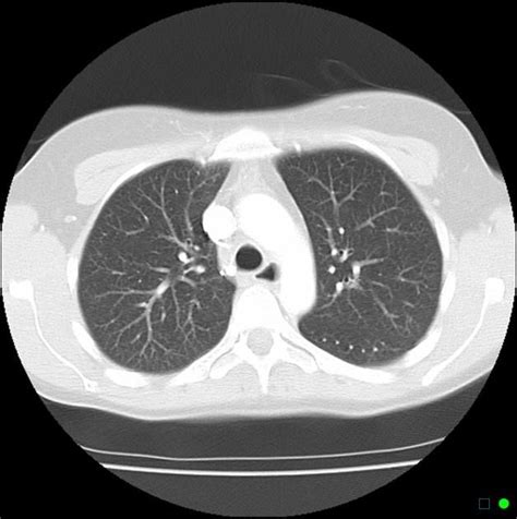 Normal chest CT - lung window Radiology Case