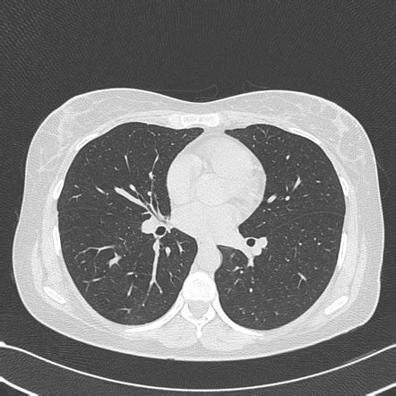 Normal chest CT Radiology Case Radiopaedia.org