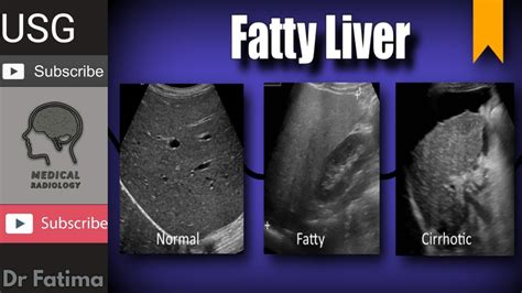 Normal echogenicity of liver meaning.  This can be a result of multiple causes wit...