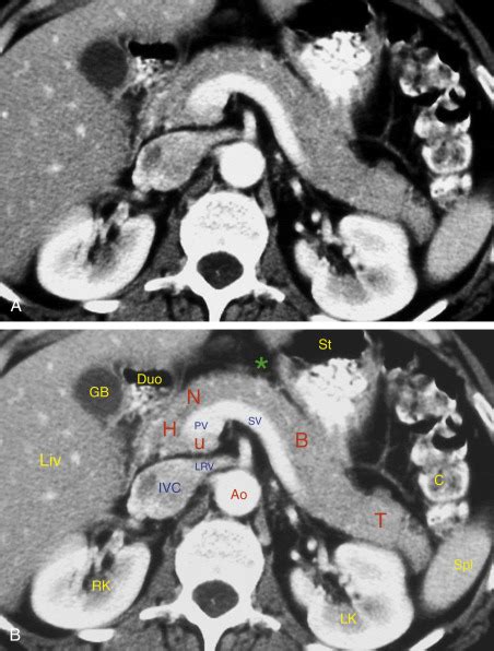 Normal pancreas ct.  J Ultrasound Med 2000;19:315-21.  Radiologists meticulously The pancreas has...