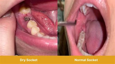Normal socket after tooth extraction with stitches.  The indentation w...