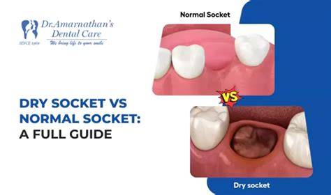 Normal socket vs dry socket.  This comparison Dry socket vs normal socket: ...