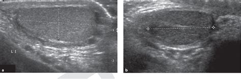 Normative values for testicular volume measured by ... - PubMed