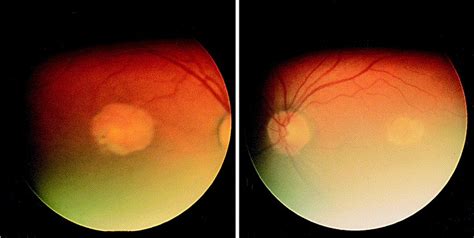 North Carolina macular dystrophy: clinicopathologic correlation.