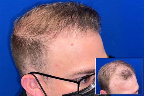 Northwestern hair restoration. Things To Know About Northwestern hair restoration. 