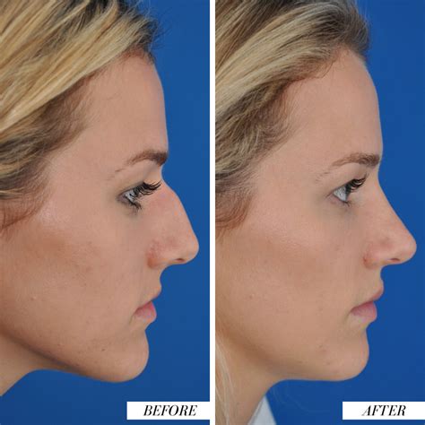 Nose job fail.  Here&rsquo;s what to know about botched rhinoplasty&mdash;how it happen...