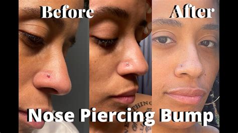 Nose piercing bump inside nose. Things To Know About Nose piercing bump inside nose. 