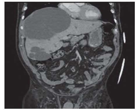 Not a Simple Cyst: Hepatic Cyst Causing Intra-cardiac Shunti ...