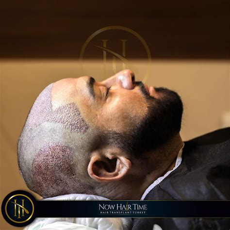 Now hair time. Now Hair Time is a hair transplant center that carries out hair, beard, mustache and eyebrow transplant in a hospital environment with its expert doctors and professional team under a doctor supervision with its years of experience. 