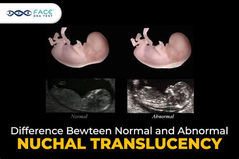 Nuchal Translucency - Audit