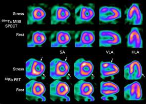 Nuclear Medicine PET Scan Cardiovascular Assessment