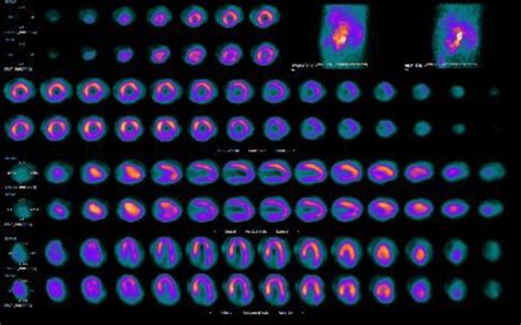 Nuclear stress test showing fixed perfusion defect in the inferior wall
